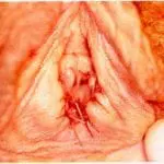 תפירת איזור החיתוך בוסטיבוליטיס