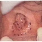 סימון איזור הכאב בוסטיבוליטיס