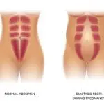 הפרדות שרירי הבטן בהריון והלידה דיאסטזיס רקטי