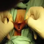 שפתיים קטנות ארוכות